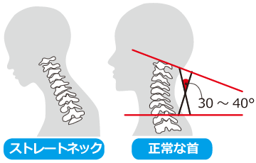 ストレートネック